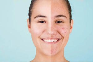 Sole e acne: perché d'estate migliora e a settembre peggiora