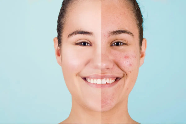 Sole e acne: perché d'estate migliora e a settembre peggiora