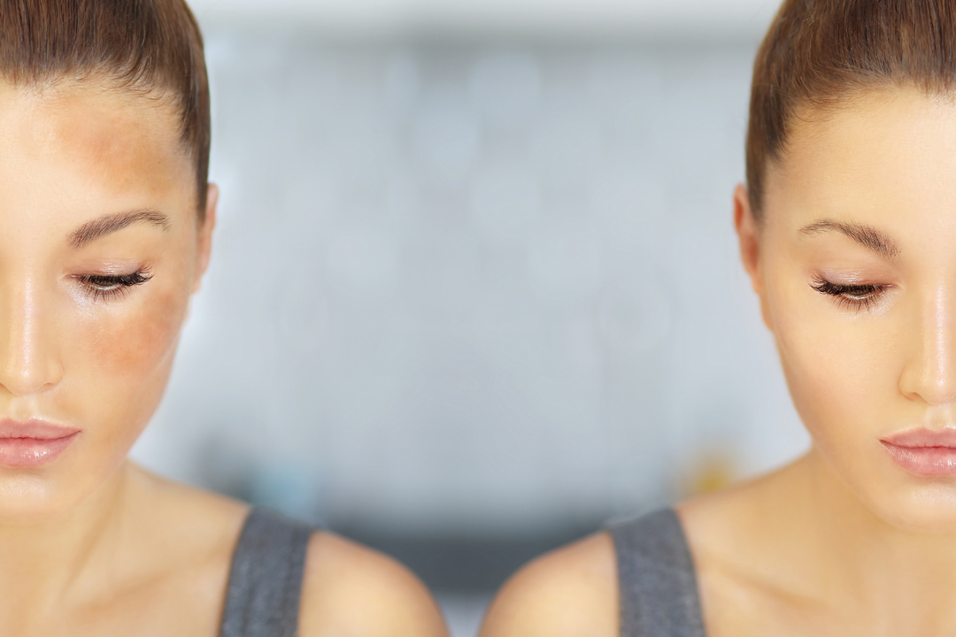 Viso con melasma e macchie scure su fronte e guance