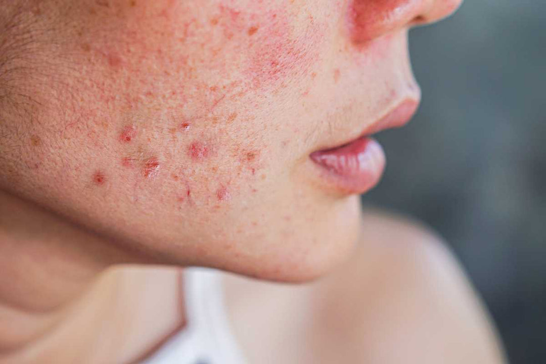 Viso con acne e imperfezioni infiammatorie