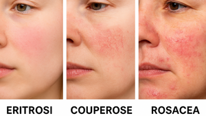 Erythrose, Couperose oder Rosazea? Wenn die Haut rot wird