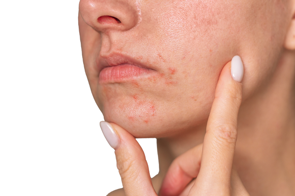 Dermatite Seborroica del Viso: sintomi e gestione cosmetica