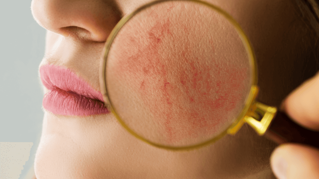 Viso femminile con pelle arrossata e infiammata