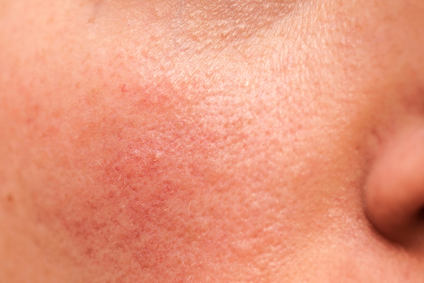 Acetyl Tetrapeptide-40: the peptide against redness and couperose