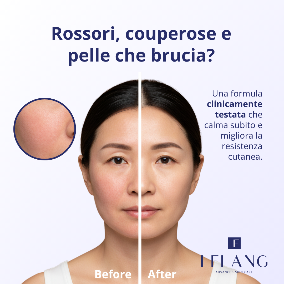 Couper Relief LeLang: rossori e couperose prima e dopo